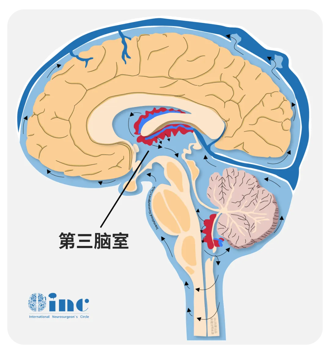 什么是腦脊液漏？