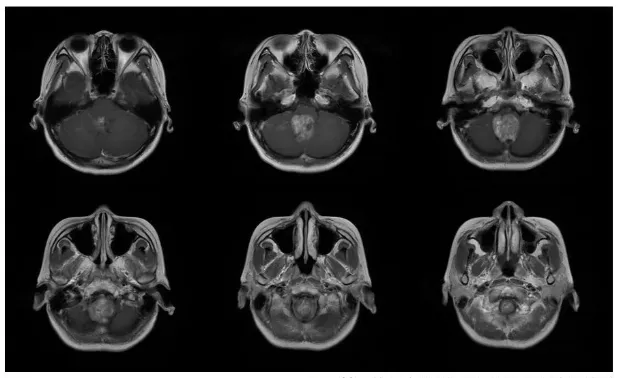 術前MRI