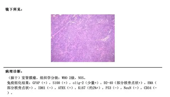 術后病理：室管膜瘤WHO 2級