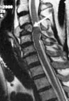 磁共振成像（MRI）結(jié)果顯示了脊髓受到壓迫的現(xiàn)象。
