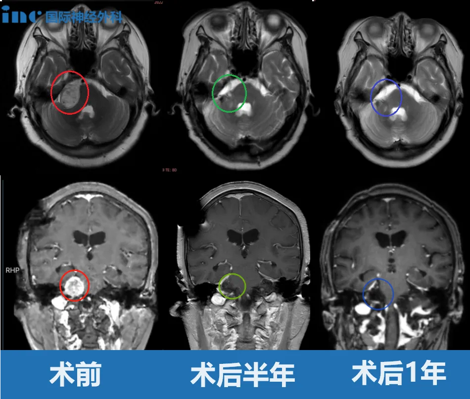 術(shù)前、術(shù)后半年與術(shù)后1年MRI對比
