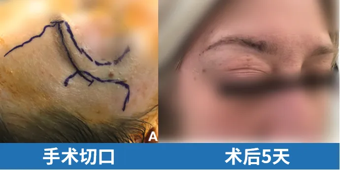 手術切口及術后5天恢復情況