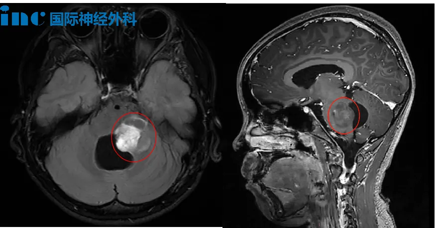 腦干是人體的“生命控制中心”，它藏在大腦深處，一度被認(rèn)為是“手術(shù)禁區(qū)”，鮮有醫(yī)生敢在其內(nèi)部及周圍實(shí)施手術(shù)，而這也成為茜茜第一次手術(shù)時(shí)的最大障礙之一