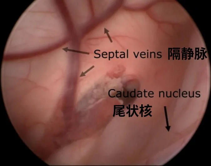 隔靜脈和尾狀核