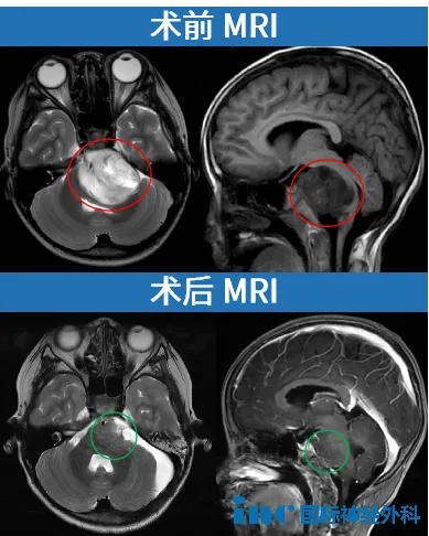 術(shù)前術(shù)后MRI
