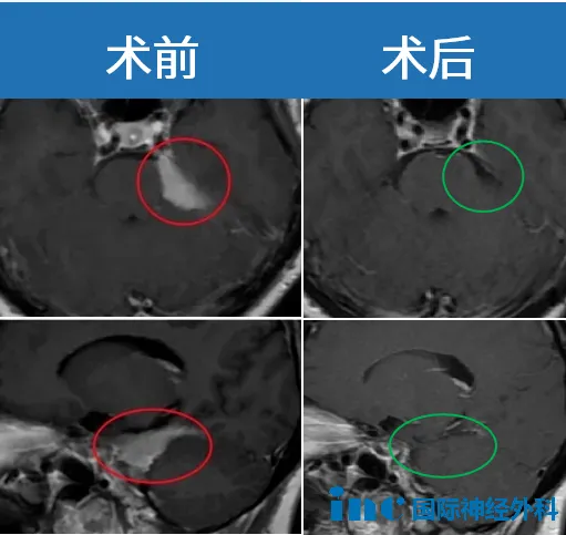 手術(shù)前后對比