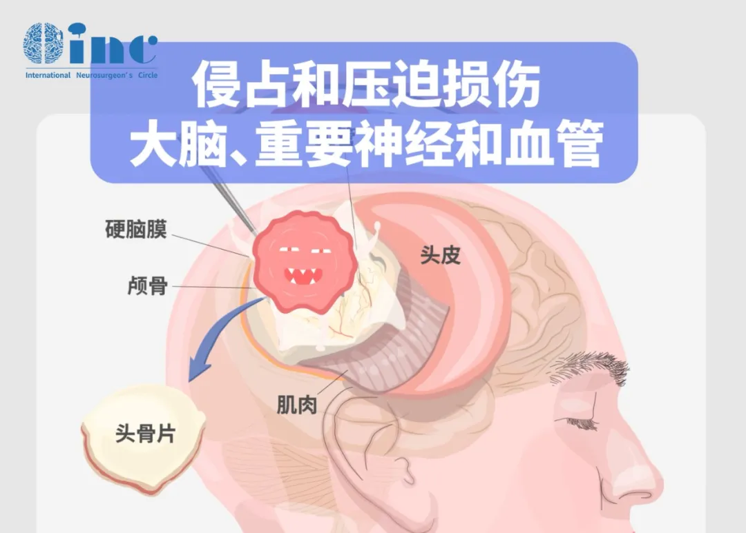 侵占和壓迫損傷大腦、重要神經(jīng)和血管