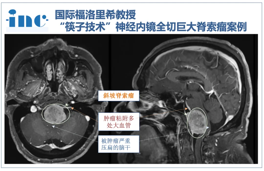 福洛里希教授“筷子技術(shù)”神經(jīng)內(nèi)鏡全切巨大脊索瘤案例