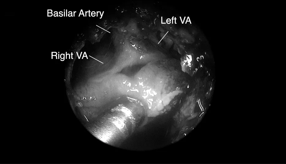 將腫瘤分離出來——Basilar Artery，基底動脈；Left VA，左側(cè)椎動脈；Right VA，右側(cè)椎動脈