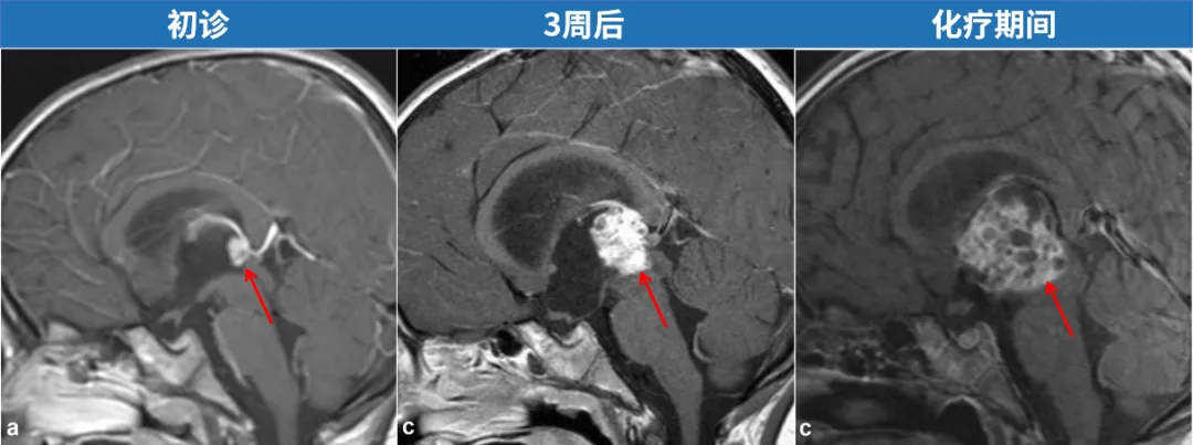 不斷長大的<a href='/naoliu/' target='_blank'><u>腦瘤</u></a>：化療、干細胞治療均無效