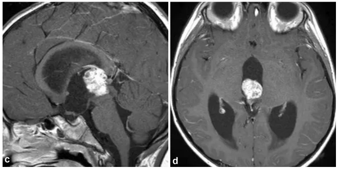 3周后的T1加權增強矢狀位（c）和軸位（d）MRI