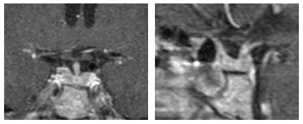 術(shù)后 1 年的術(shù)后 MRI 復(fù)查顯示腫瘤完全切除以及正常的垂體腺。