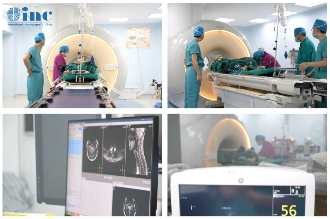 術(shù)中核磁（intraoperative MRI，簡(jiǎn)稱(chēng)iMRI，又稱(chēng)術(shù)中磁共振）能夠在手術(shù)過(guò)程中的任何時(shí)刻確定大腦內(nèi)腫瘤的準(zhǔn)確位置，使術(shù)中“實(shí)時(shí)”（real-time）成像成為可能，從而為神經(jīng)外科醫(yī)生提供了實(shí)時(shí)更新的腦部GPS影像地圖