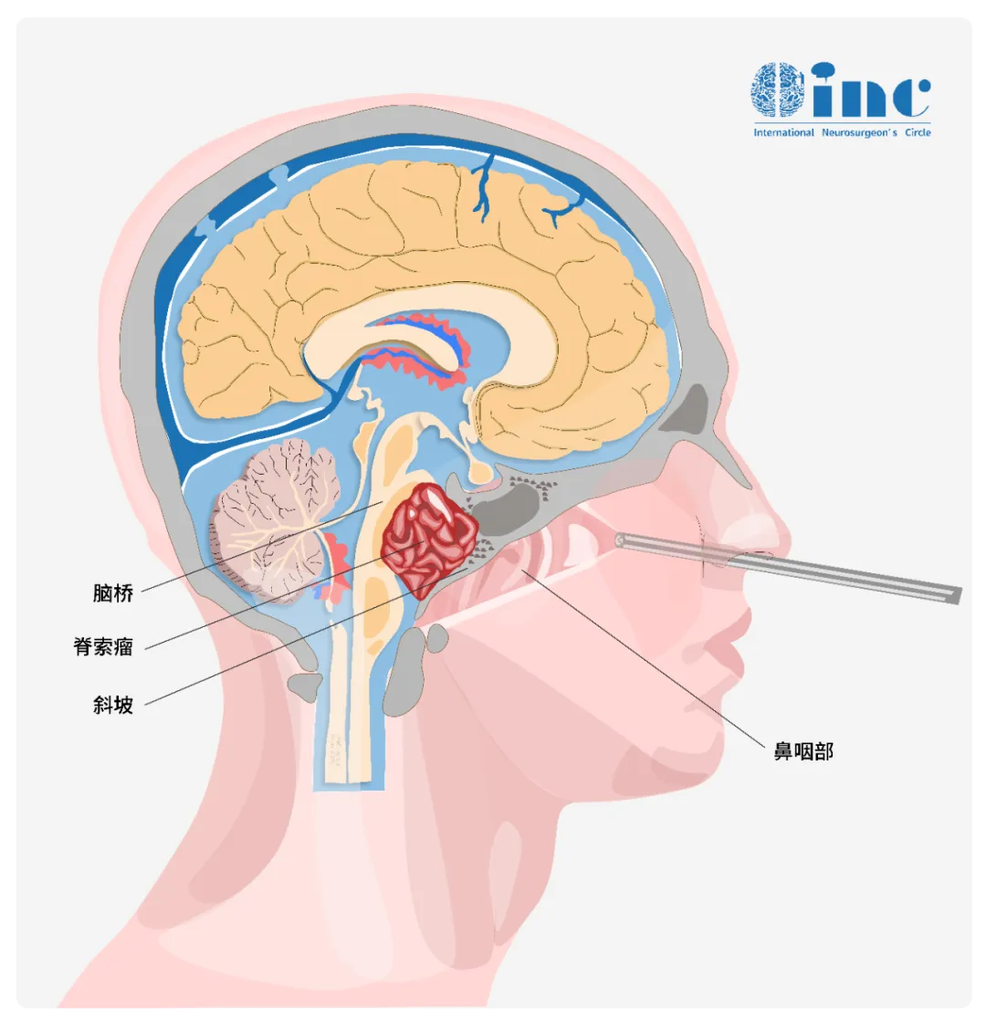 顯微鏡+神經內鏡-“雙鏡聯合”的手術