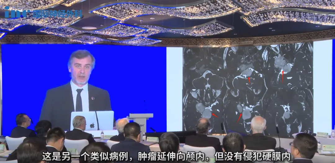 腫瘤尚未侵犯硬膜內，因此必須立即采取行動