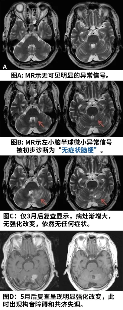 一個(gè)膠質(zhì)瘤從無(wú)到有的完整發(fā)展史