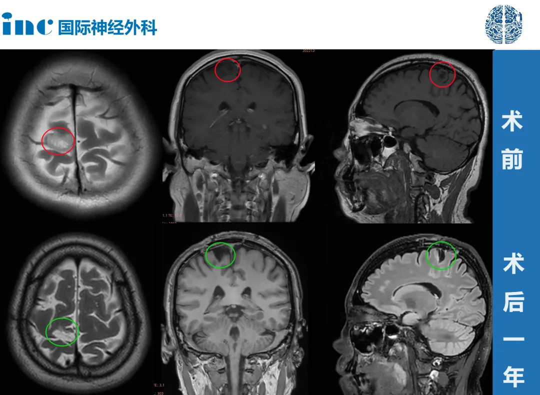 41歲女性——額葉低級(jí)別膠質(zhì)瘤