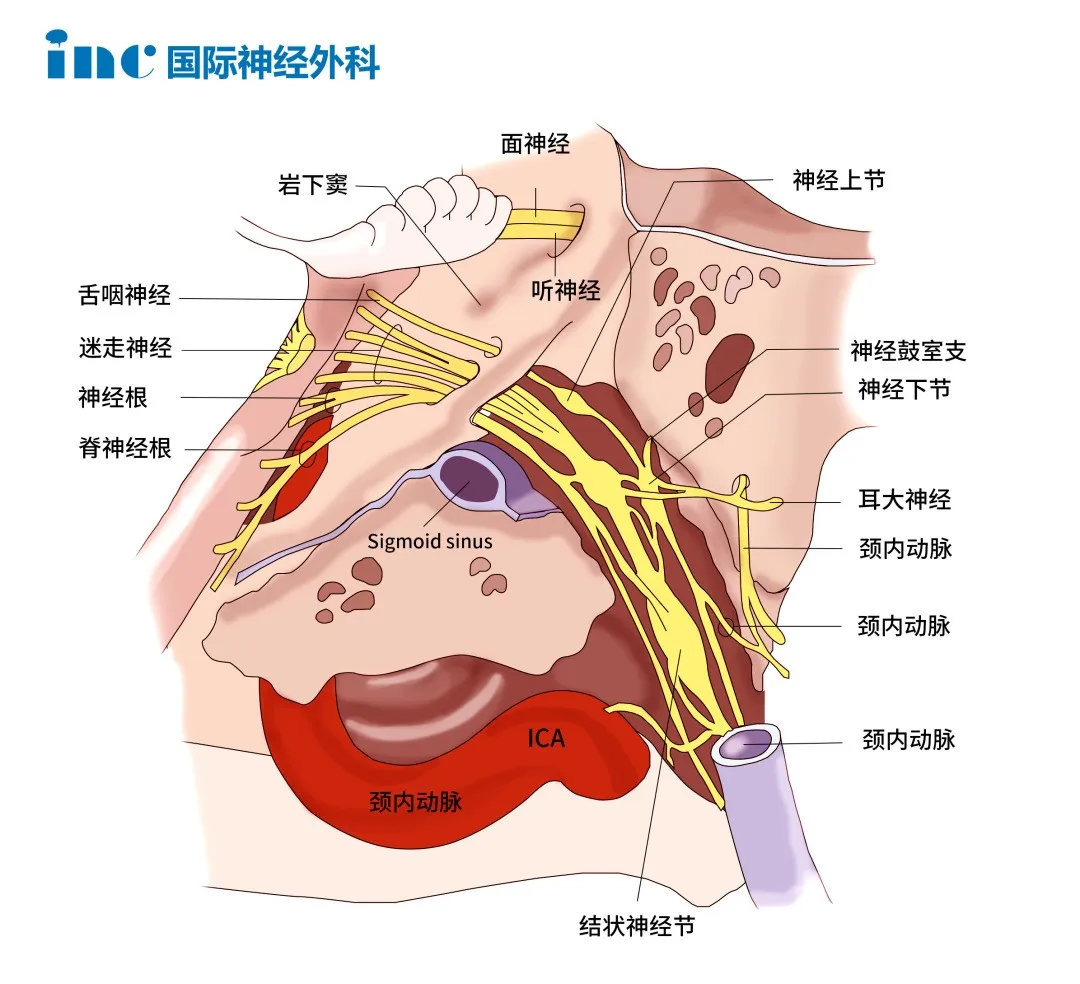 手術(shù)盡可能保護(hù)后組顱神經(jīng)，頸靜脈孔區(qū)復(fù)雜的神經(jīng)血管