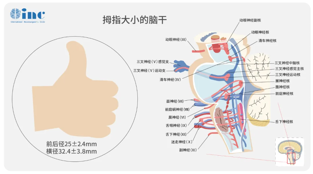 INC德國巴特朗菲教授揭秘：腦干海綿狀血管瘤出血風(fēng)險(xiǎn)與切除策略
