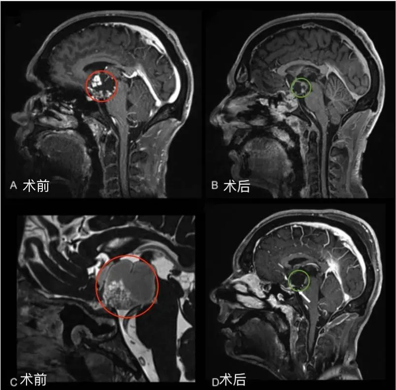 福洛里希教授采用單鼻孔經(jīng)鼻內(nèi)鏡及顯微鏡開顱手術(shù)，在最大程度地保護(hù)神經(jīng)功能的基礎(chǔ)上，實(shí)現(xiàn)了腫瘤的安全全切。