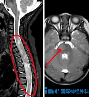 教授回復(fù)：在靶向治療期間神經(jīng)系統(tǒng)癥狀似乎在逐漸惡化，所以我認(rèn)為要么換一種新的靶向藥物，要么就該考慮手術(shù)?，F(xiàn)在腿部不能動，部分原因是因?yàn)榧顾枋艿侥[瘤的壓力。必須通過手術(shù)緩解部分壓力，脊髓功能才可能恢復(fù)。我們應(yīng)當(dāng)采取 “安全 + 有效”的手術(shù)策略，結(jié)合術(shù)后病理結(jié)果制定新的靶向治療。我不建議等待太久，建議在接下來一到三個(gè)月內(nèi)進(jìn)行手術(shù)。我認(rèn)為手術(shù)和靶向治療聯(lián)合使用，有可能帶來恢復(fù)。