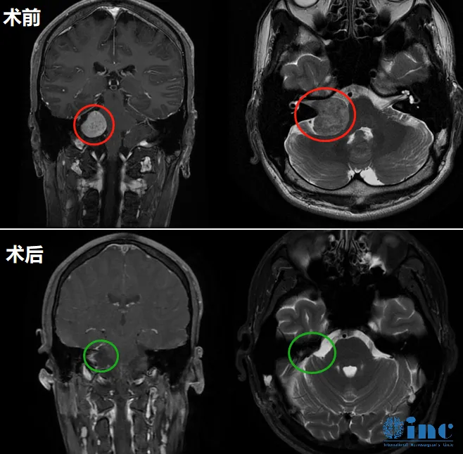 聽神經(jīng)瘤放療失敗后還能手術(shù)嗎？醫(yī)生：風(fēng)險或翻倍！