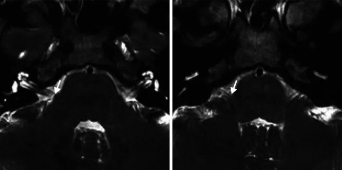 磁共振成像（MRI）采用穩(wěn)態(tài)構建干擾序列未顯示血管壓迫