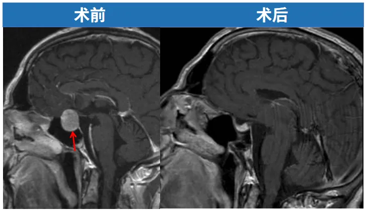 無需開顱、腫瘤被成功全切  恢復(fù)良好且無需激素替代治療