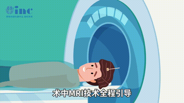 膠質(zhì)瘤術(shù)后7年復(fù)發(fā)新選擇：不開顱的LITT技術(shù)控住癲癇