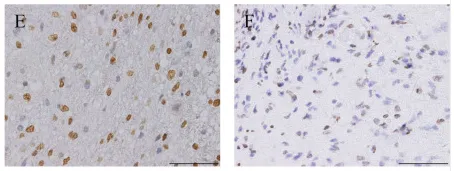 檢測提示為H3 K27M突變型彌漫性中線膠質(zhì)瘤（DMG），免疫組化進一步證實H3 K27me3表達缺失