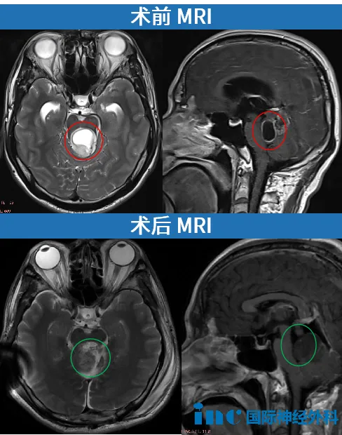 術(shù)后病理結(jié)果顯示，該腫瘤為高級別膠質(zhì)瘤，Ki67指數(shù)高達15%