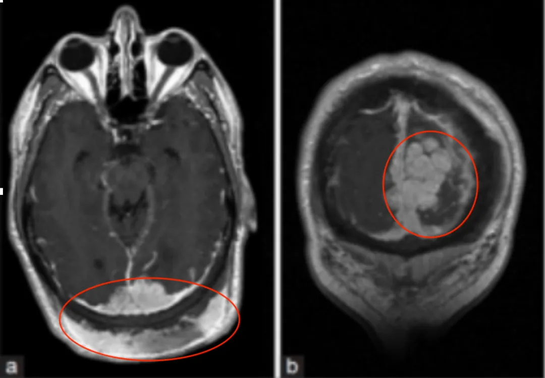 大腦的磁共振成像和磁共振血管造影(MRI/MRA)，結果顯示一個11×5cm的腫塊，向上和下延伸至雙側頂葉和枕葉、上矢狀竇、小腦環(huán)和近端橫竇。