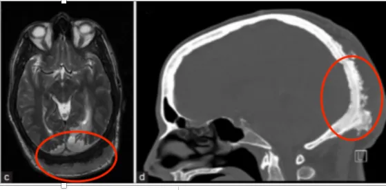 軸向（a）和冠狀（b）對比增強的T1加權MRI證實腫瘤包裹著上矢狀竇的后部。觀察到后頭皮異常增厚。（c）軸向T2加權MRI序列顯示枕葉白質(zhì)異常高強度，與實質(zhì)性腫瘤浸潤引起的血管性水腫一致。（d）增強CT掃描，顯示枕骨由于腫瘤浸潤而變厚的骨質(zhì)肥大。