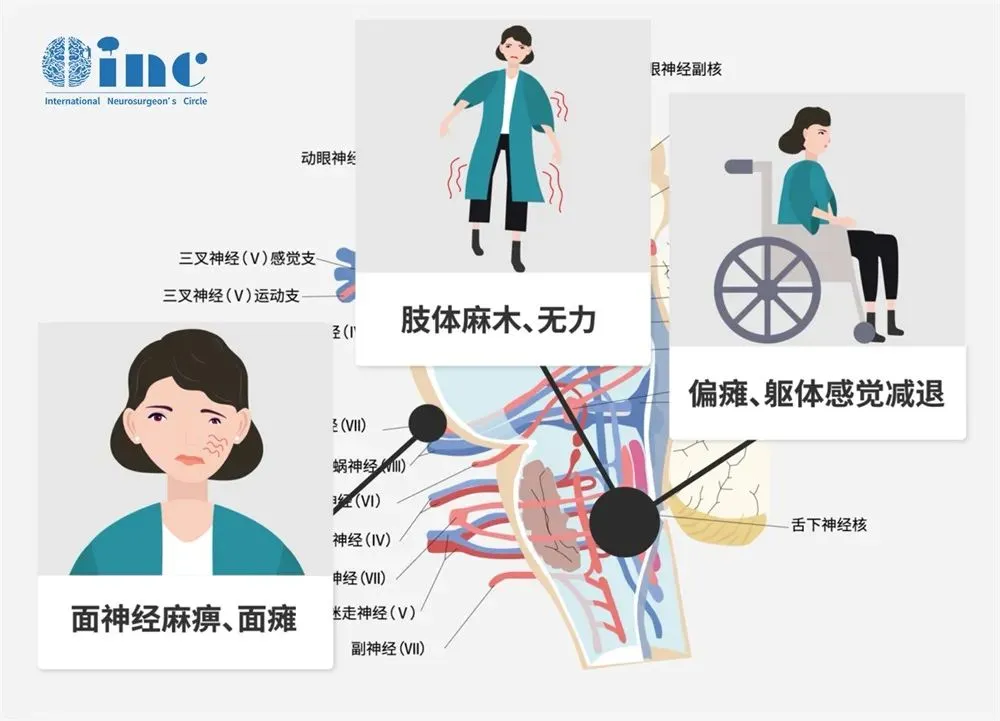面神經(jīng)麻痹、面癱；肢體麻木、無力；偏癱、軀體感覺衰退