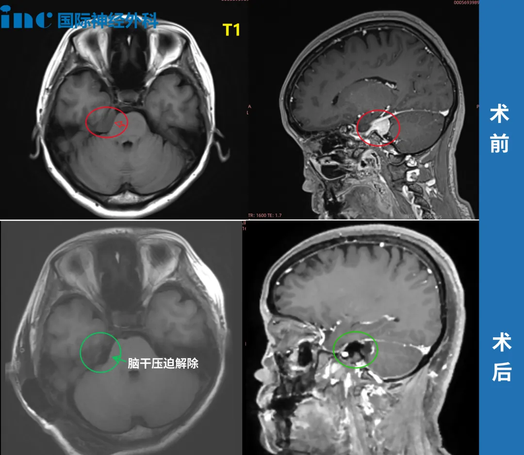 體檢發(fā)現(xiàn)腦瘤是否會(huì)誤判？無癥狀腦瘤治不治？
