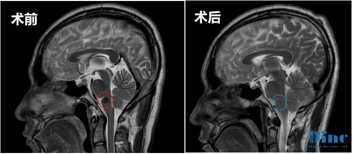 術(shù)前術(shù)后MRI對比