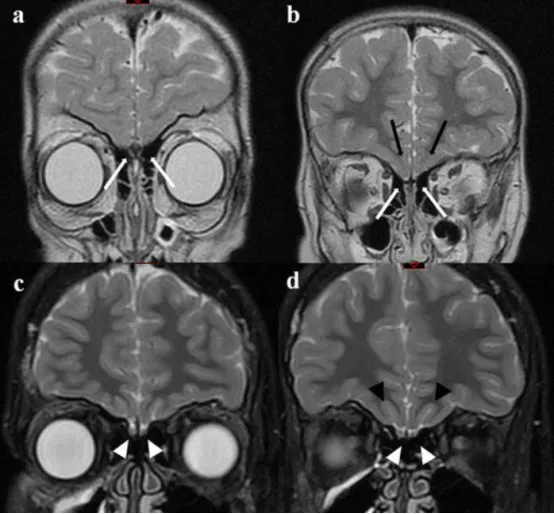 8 歲 KS 女童的 MRI 冠狀面視圖。嗅球缺失（a，白箭頭），嗅束亦缺失（b，白箭頭）。嗅溝雙側(cè)缺失，右側(cè)眶回與眶溝界限不清（b，黑箭頭）；10 歲健康男童的 MRI 冠狀面視圖?？梢娬５男崆颍╟，白箭頭）和嗅束（d，白箭頭），眶溝雙側(cè)正常（d，黑箭頭），右側(cè)眶回與眶溝界限清晰。