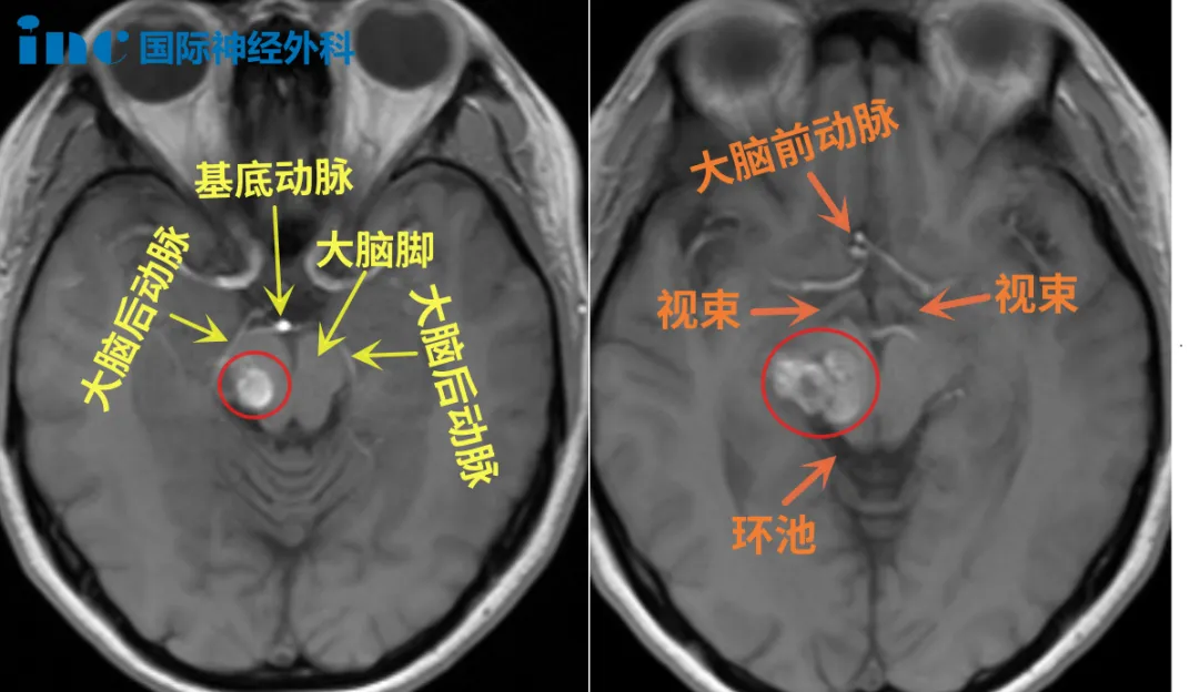 不同于第1次丘腦出血，這次是腦干附近的再次出血：手麻、心悸、早搏