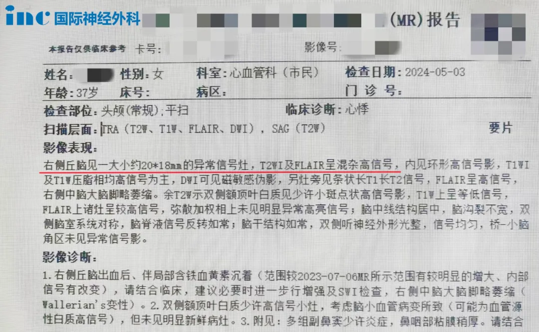 右側(cè)丘腦見一大小約20*18mm的異常信號灶，T2WI及FLAIR呈混雜高信號
