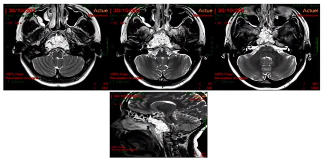 這是術(shù)后的MRI，高信號(hào)的是脂肪組織