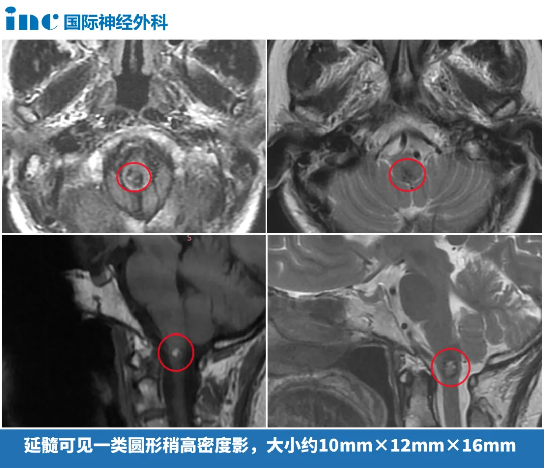 延髓可見一類圓形稍高密度影，大小約10mmx12mmx16mm