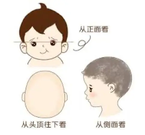 診斷  矢狀縫早閉大都可通過視診或觸診發(fā)現(xiàn)