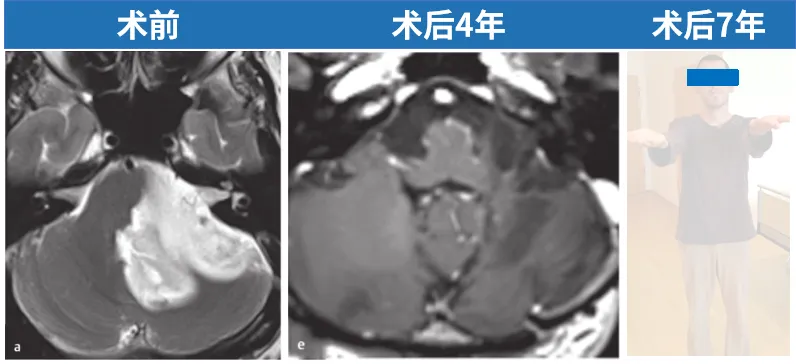 INC巴教授強(qiáng)調(diào)：對腦干膠質(zhì)瘤不應(yīng)一概而論地貼上 “不可手術(shù)” 標(biāo)簽。在許多情況下，顯微外科腫瘤切除是可行的，但必須嚴(yán)格篩選患者。尤其對于低級別患者，尤其是毛細(xì)胞星形細(xì)胞瘤患者，我們甚至可以治愈他們，治愈意味著至少25年無腫瘤進(jìn)展，而我已經(jīng)治愈了其中的一些患者。