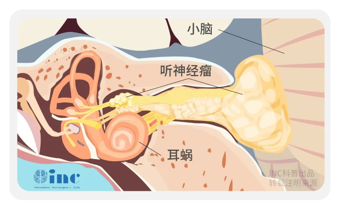 4000多例聽(tīng)神經(jīng)瘤患者研究：1/3病例3年腫瘤有進(jìn)展