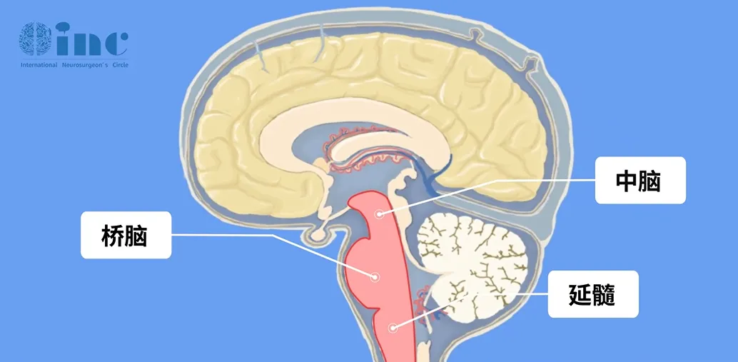 腦橋出血量少時，表現(xiàn)為突然頭痛、嘔吐、眩暈、復視、四肢癱瘓；出血量大時，患者很快出現(xiàn)意識障礙、針尖樣瞳孔、四肢癱瘓、呼吸障礙、高熱，?？稍?8小時內(nèi)死亡。