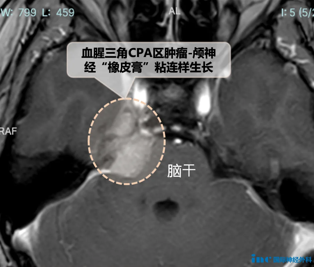 血腥三角CPA區(qū)腫瘤-顱神經(jīng)“橡皮膏”粘連樣生長