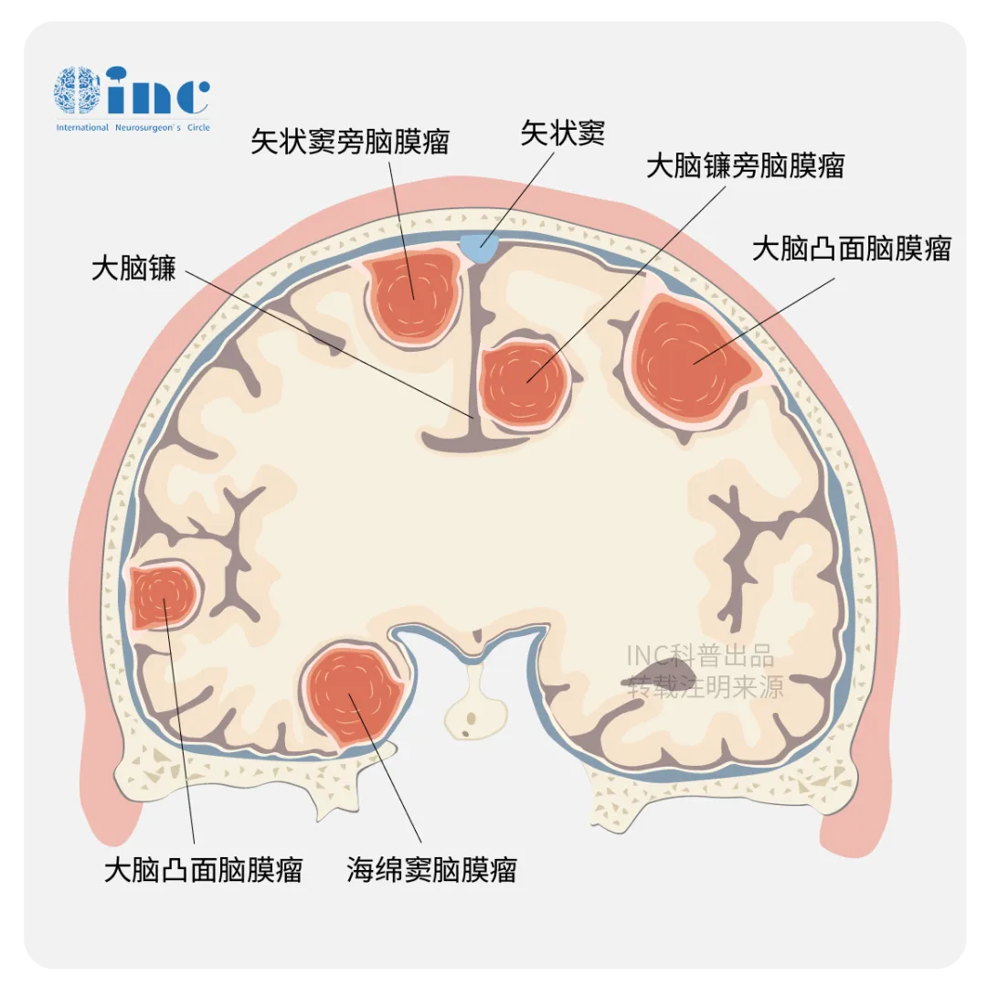 腦膜瘤的“作惡多端”在于破壞力，會侵襲腦實(shí)質(zhì)和顱神經(jīng)，侵襲動脈靜脈，侵襲骨質(zhì)造成骨質(zhì)破壞，引起神經(jīng)功能問題