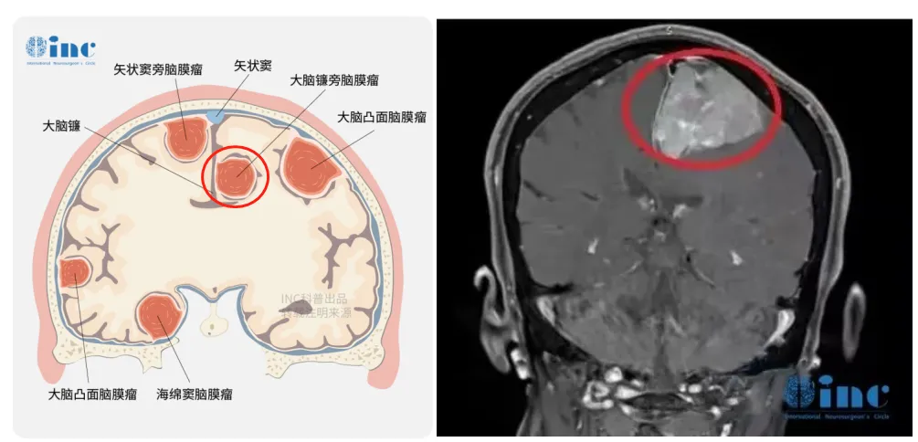 左側(cè)額部大腦鐮旁腦膜瘤