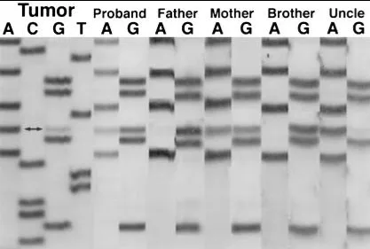圖 3 為對先證者腫瘤、先證者種系以及母親種系 DNA 的 hSNF5 第 7 外顯子進(jìn)行測序，顯示在先證者腫瘤、先證者種系及母親種系 DNA 中存在 G→A 突變（雙箭頭），而先證者父親和兄弟的白細(xì)胞 DNA 顯示野生型序列。先證者腫瘤和其叔叔的腫瘤（Uncle）顯示出相同的 G→A 突變。