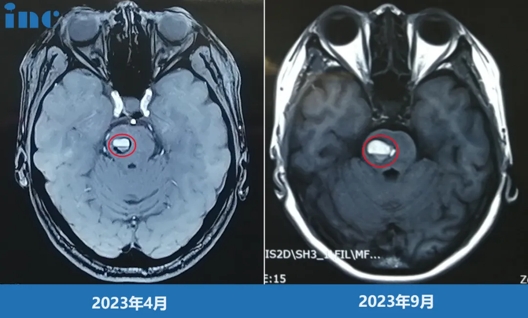 影像對(duì)比提示金女士的海綿狀血管瘤增大  出血量逐漸增多